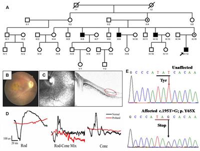 Recapitulating X-Linked Juvenile Retinoschisis in Mouse Model by Knock-In Patient-Specific Novel Mutation